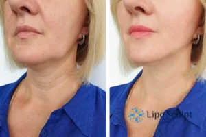 Book your double chin treatment Croydon today! We are here to help!