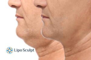 Double chin treatment Croydon from Lipo Sculpt - feel more confident today!