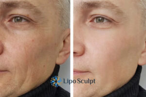 How to Fight Aging Symptoms 3 Fight Aging Symptoms Croydon With HIFU and Morpheus8 Today!
