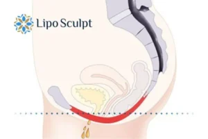 Pelvic Floor Chair Therapy Croydon to treat incontinence.